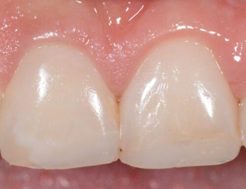 Sbiancamento di un dente devitalizzato